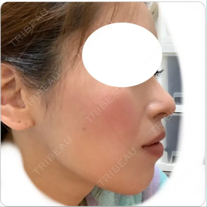 鼻尖形成（切開） / 鼻中隔延長（切開） / 軟骨移植 / 鼻尖縮小 エートップ美容整形外科 DAY 308 メイン用