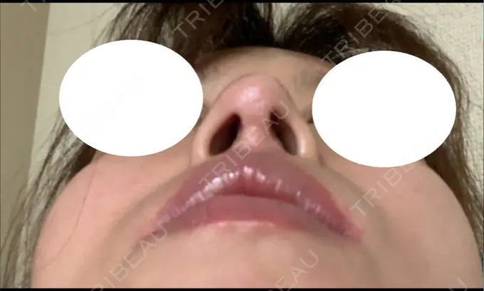 鼻尖形成（切開） / 鼻中隔延長（切開） / 軟骨移植 / 鼻尖縮小 エートップ美容整形外科 DAY 308 メイン用