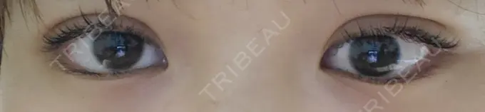 二重埋没 城本クリニック 名古屋院 DAY 4 メイン用