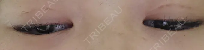 二重埋没 城本クリニック 名古屋院 DAY 4 メイン用