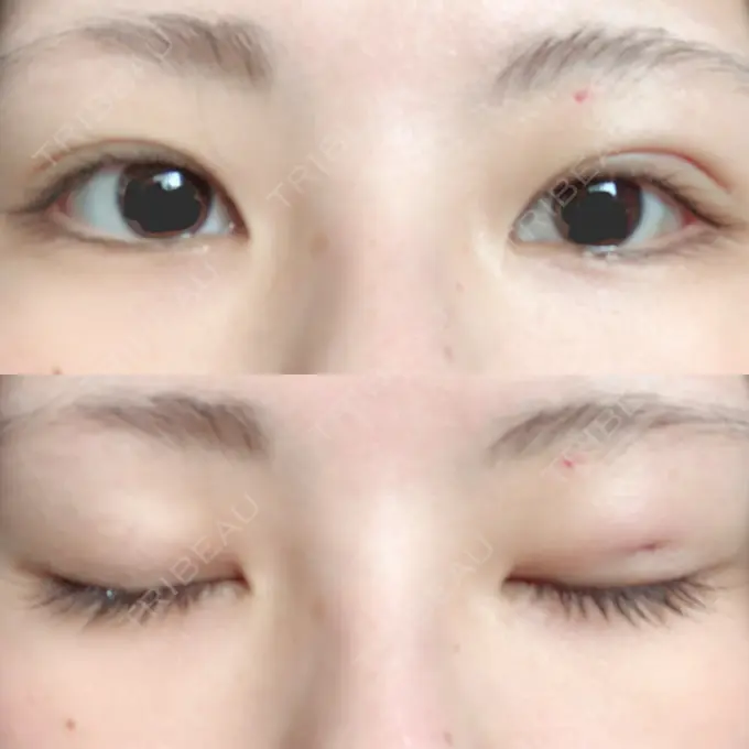 眼瞼下垂（切開） / その他（肌） La Clinique Shinjuku 【ラクリニック 新宿】 DAY 2 メイン用