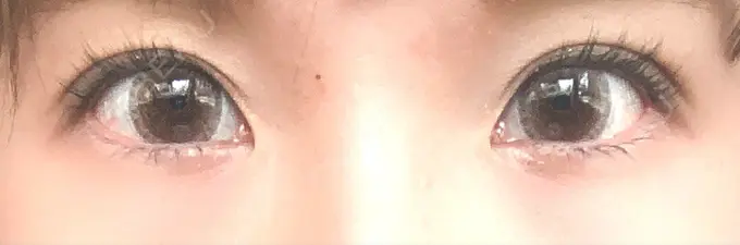 二重埋没 湘南美容クリニック 札幌院 DAY 31 メイン用