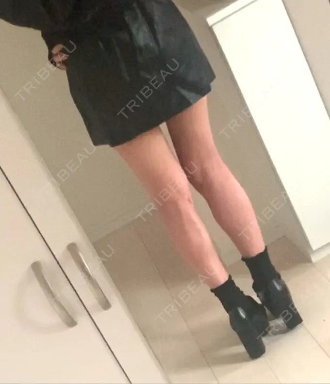 脂肪吸引（脚） / 脂肪吸引（お尻） / ボトックス（ふくらはぎ） / その他（ボディ） YumaStem美容外科 DAY 81 メイン用