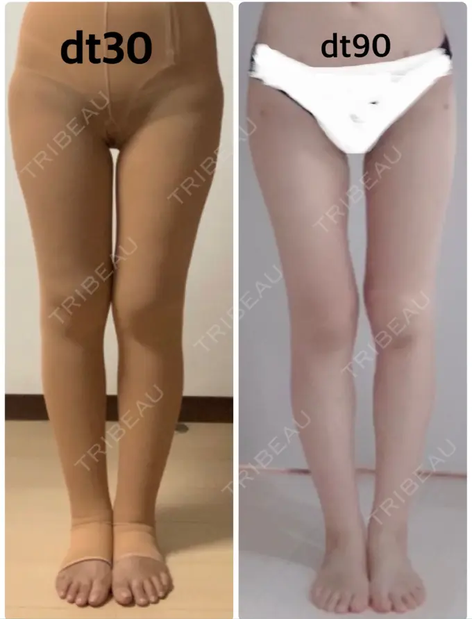 脂肪吸引（脚） / 脂肪吸引（お尻） / ボトックス（ふくらはぎ） / その他（ボディ） YumaStem美容外科 DAY 90 メイン用