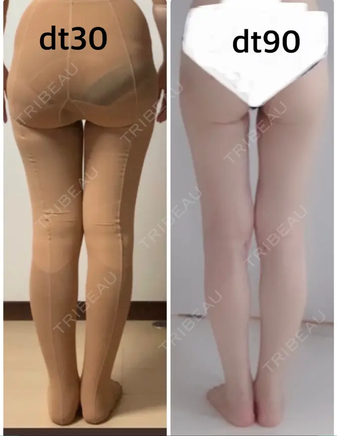 脂肪吸引（脚） / 脂肪吸引（お尻） / ボトックス（ふくらはぎ） / その他（ボディ） YumaStem美容外科 DAY 90 メイン用