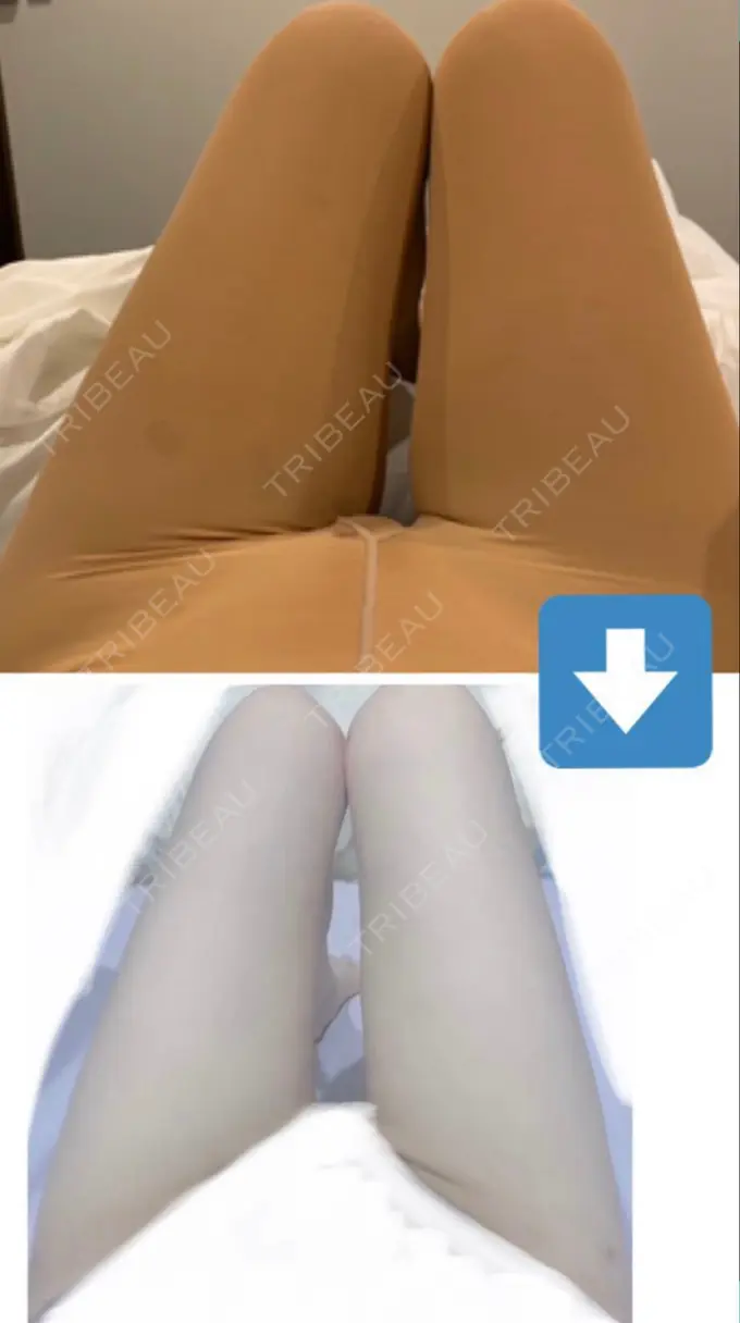 脂肪吸引（脚） / 脂肪吸引（お尻） / ボトックス（ふくらはぎ） / その他（ボディ） YumaStem美容外科 DAY 90 メイン用