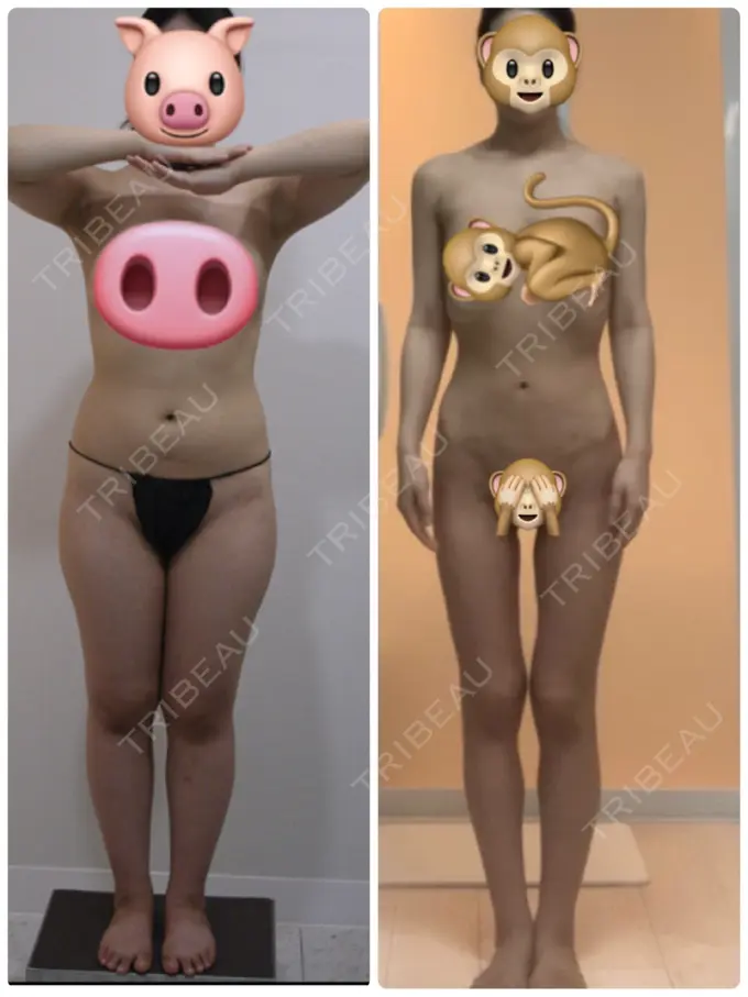 脂肪吸引（脚） / 脂肪吸引（お尻） / ボトックス（ふくらはぎ） / その他（ボディ） YumaStem美容外科 AFTER メイン用