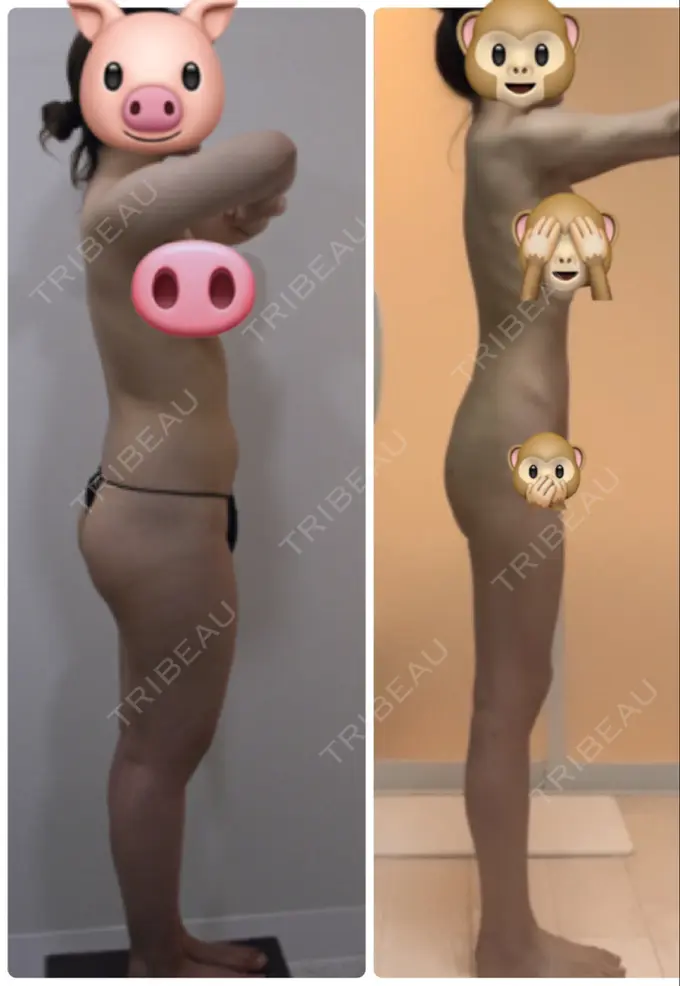 脂肪吸引（脚） / 脂肪吸引（お尻） / ボトックス（ふくらはぎ） / その他（ボディ） YumaStem美容外科 DAY 160 メイン用