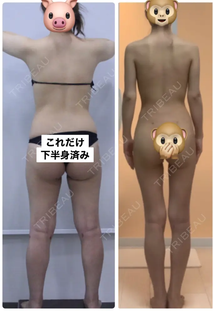 脂肪吸引（脚） / 脂肪吸引（お尻） / ボトックス（ふくらはぎ） / その他（ボディ） YumaStem美容外科 DAY 160 メイン用