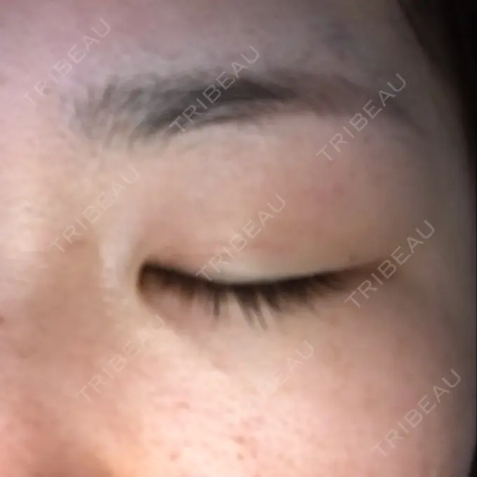 二重埋没 城本クリニック 名古屋院 DAY 164 メイン用