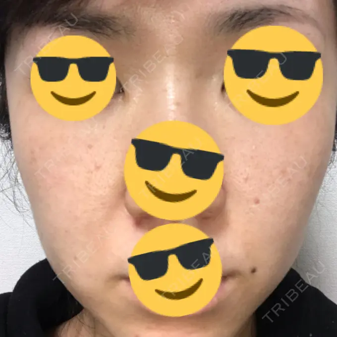 水光注射（ハリ・美肌） / 脂肪溶解注射（顔） / その他（肌） / 美白レーザー / ピコレーザートーニング（美白・肝斑） / 医療脱毛（脚） リエンジャン整形外科 江南店 DAY 3 メイン用