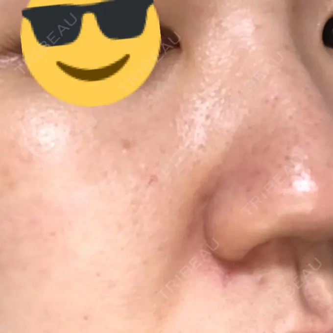 水光注射（ハリ・美肌） / 脂肪溶解注射（顔） / その他（肌） / 美白レーザー / ピコレーザートーニング（美白・肝斑） / 医療脱毛（脚） リエンジャン整形外科 江南店 DAY 3 メイン用