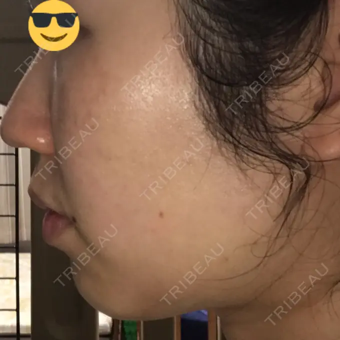 水光注射（ハリ・美肌） / 脂肪溶解注射（顔） / その他（肌） / 美白レーザー / ピコレーザートーニング（美白・肝斑） / 医療脱毛（脚） リエンジャン整形外科 江南店 DAY 3 メイン用