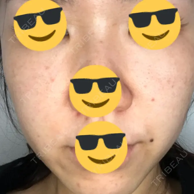 水光注射（ハリ・美肌） / 脂肪溶解注射（顔） / その他（肌） / 美白レーザー / ピコレーザートーニング（美白・肝斑） / 医療脱毛（脚） リエンジャン整形外科 江南店 DAY 8 メイン用