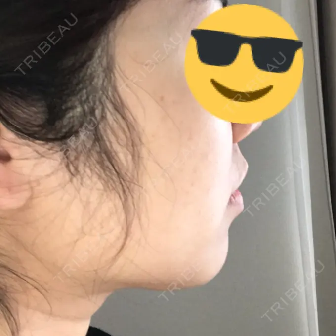 水光注射（ハリ・美肌） / 脂肪溶解注射（顔） / その他（肌） / 美白レーザー / ピコレーザートーニング（美白・肝斑） / 医療脱毛（脚） リエンジャン整形外科 江南店 DAY 8 メイン用