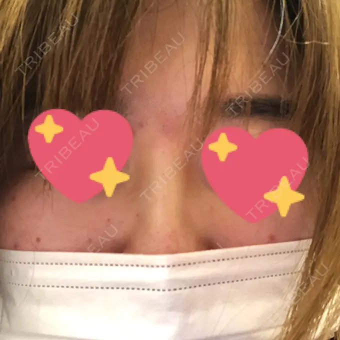 ヒアルロン酸注入（鼻） 品川美容外科 福岡院 DAY 8 メイン用