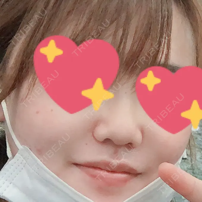 ヒアルロン酸注入（鼻） 品川美容外科 福岡院 DAY 9 メイン用