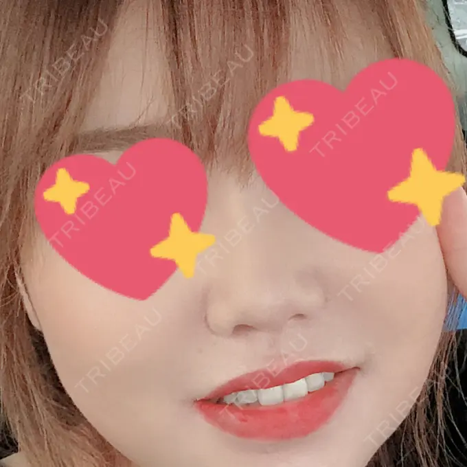 ヒアルロン酸注入（鼻） 品川美容外科 福岡院 DAY 10 メイン用