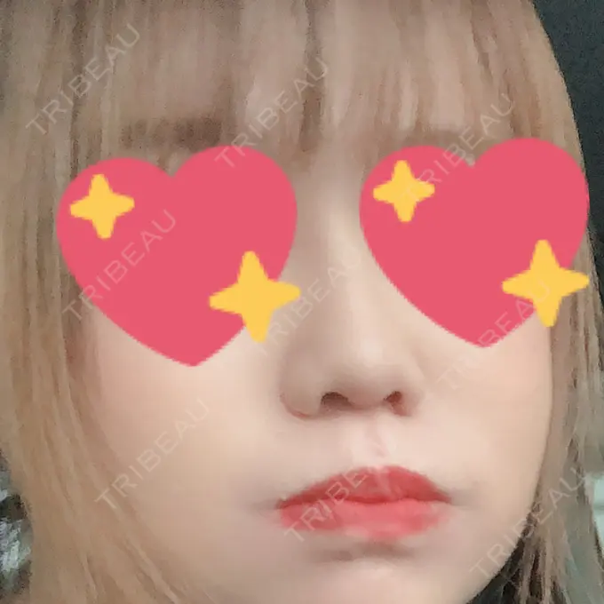 ヒアルロン酸注入（鼻） 品川美容外科 福岡院 DAY 10 メイン用