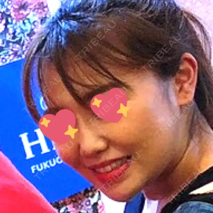 ヒアルロン酸注入（鼻） 品川美容外科 福岡院 DAY 10 メイン用