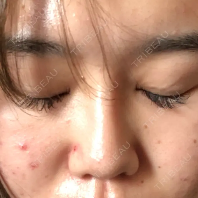 ヒアルロン酸注入（鼻） 品川美容外科 福岡院 AFTER メイン用