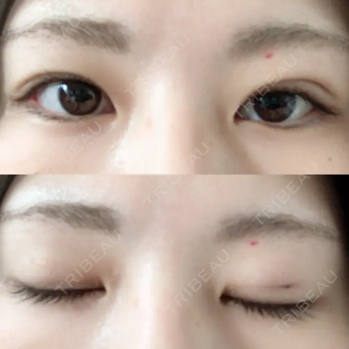 眼瞼下垂（切開） / その他（肌） La Clinique Shinjuku 【ラクリニック 新宿】 DAY 3 メイン用