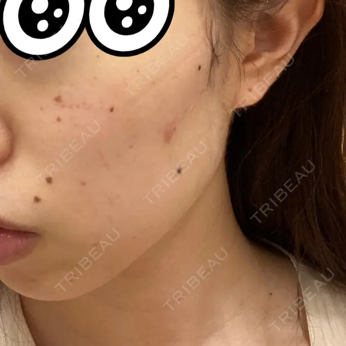 シミ取りレーザー 赤坂プレミアクリニック DAY 0 メイン用