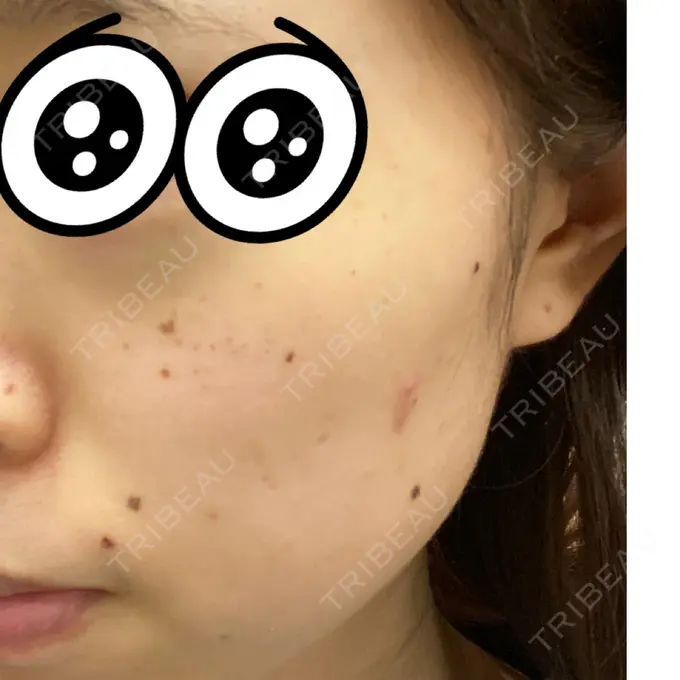 シミ取りレーザー 赤坂プレミアクリニック DAY 1 メイン用