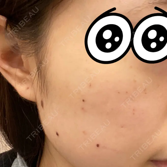 シミ取りレーザー 赤坂プレミアクリニック DAY 1 メイン用