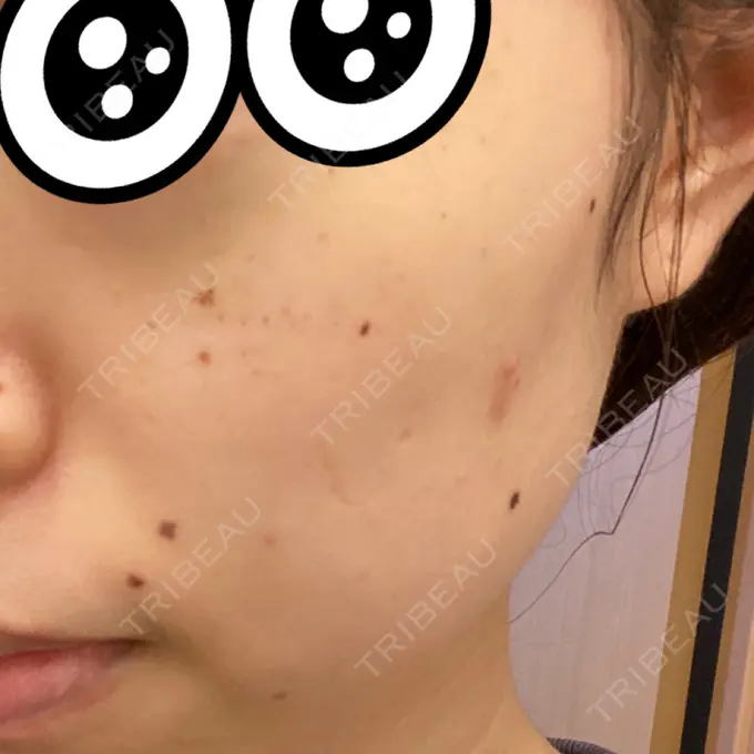 シミ取りレーザー 赤坂プレミアクリニック DAY 2 メイン用