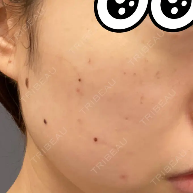 シミ取りレーザー 赤坂プレミアクリニック DAY 2 メイン用