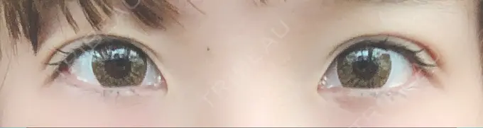 二重埋没 湘南美容クリニック 札幌院 DAY 34 メイン用