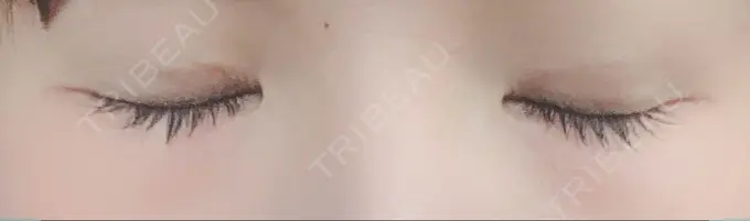 二重埋没 湘南美容クリニック 札幌院 DAY 34 メイン用