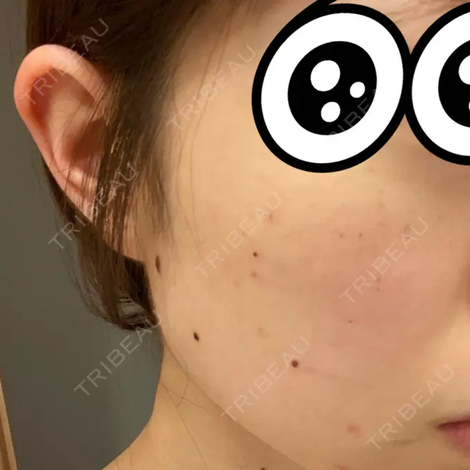 シミ取りレーザー 赤坂プレミアクリニック DAY 3 メイン用