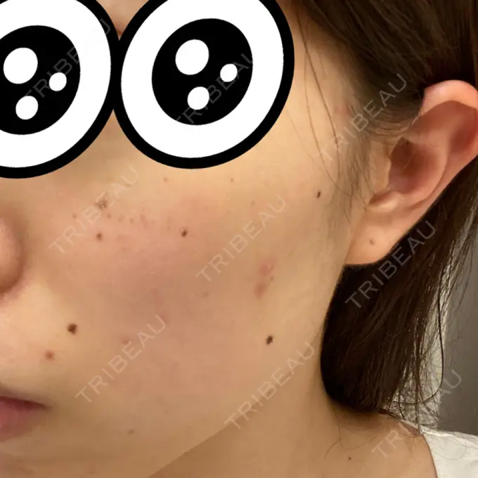 シミ取りレーザー 赤坂プレミアクリニック DAY 3 メイン用