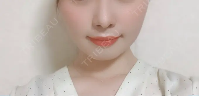 脂肪溶解注射（顔） 赤坂プレミアクリニック DAY 19 メイン用