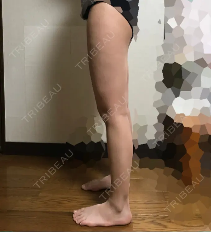 脂肪吸引（脚） / 豊胸（脂肪注入） ドクターフィット（Dr.fit）クリニック DAY 129 メイン用