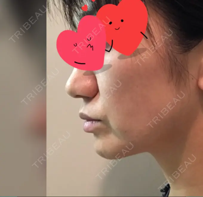 脂肪溶解注射（顔） TCB東京中央美容外科 心斎橋筋院 DAY 0 メイン用