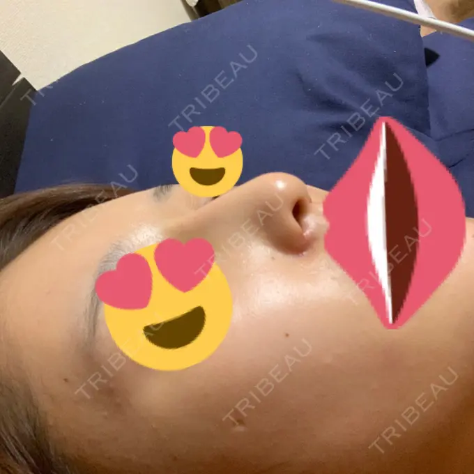 隆鼻術 / 鼻尖形成（切開） / 小鼻縮小（切開） / ボトックス（エラ・小顔） / その他（鼻） ルラ美容クリニック 高田馬場院 DAY 33 メイン用