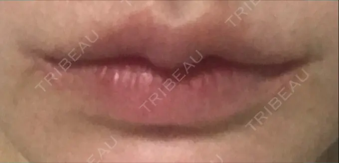 口角挙上 現代美学整形外科 DAY 70 メイン用