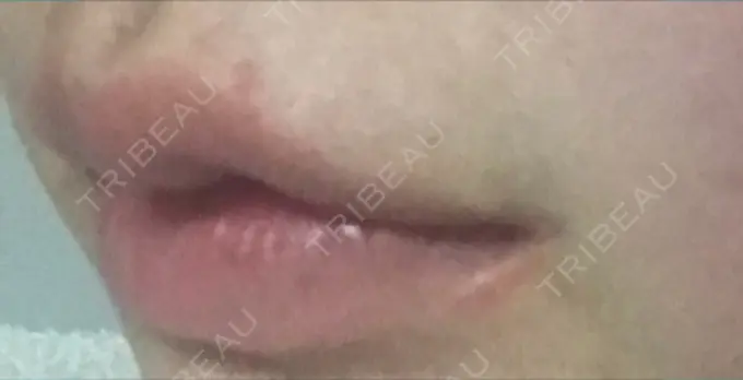 口角挙上 現代美学整形外科 DAY 70 メイン用