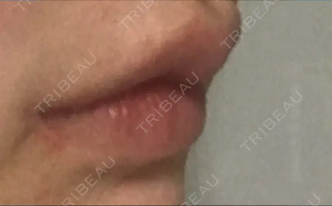 口角挙上 現代美学整形外科 DAY 70 メイン用