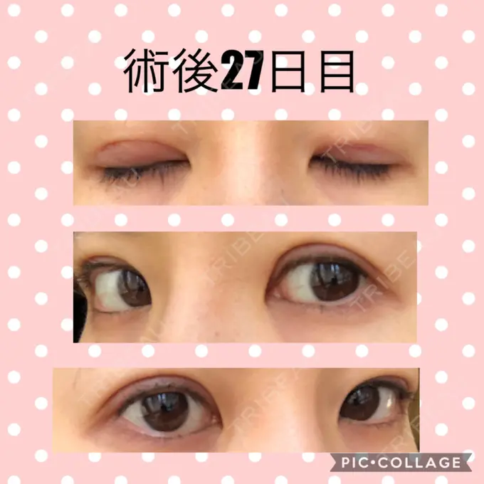 二重切開 マリアクリニック 安城院 DAY 27 メイン用