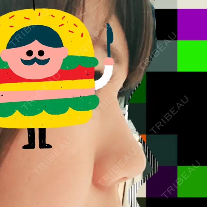 レディエッセ注入（鼻） 赤坂プレミアクリニック AFTER メイン用