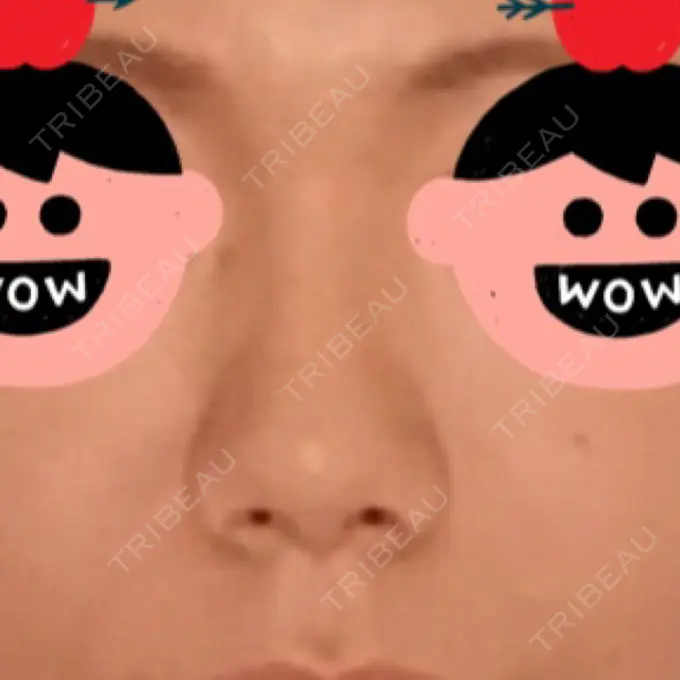 レディエッセ注入（鼻） 赤坂プレミアクリニック DAY 141 メイン用