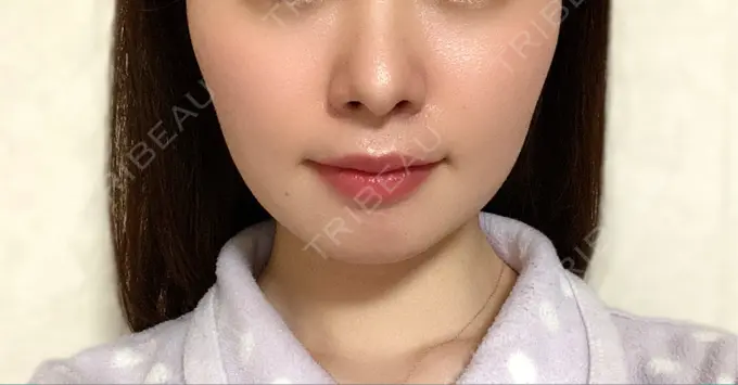 脂肪溶解注射（顔） 赤坂プレミアクリニック DAY 21 メイン用