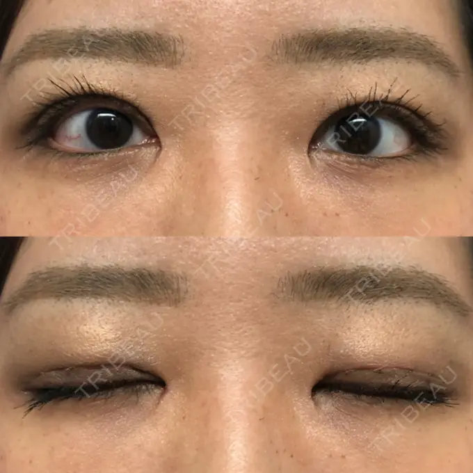 二重切開 / 目頭切開 / その他（目元） 新前橋かしま眼科形成外科クリニック DAY 13 メイン用