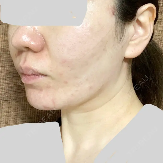 糸リフト / 肌ヒアルロン酸注入（たるみ・シワ改善） TCB東京中央美容外科 中野院 DAY 0 メイン用