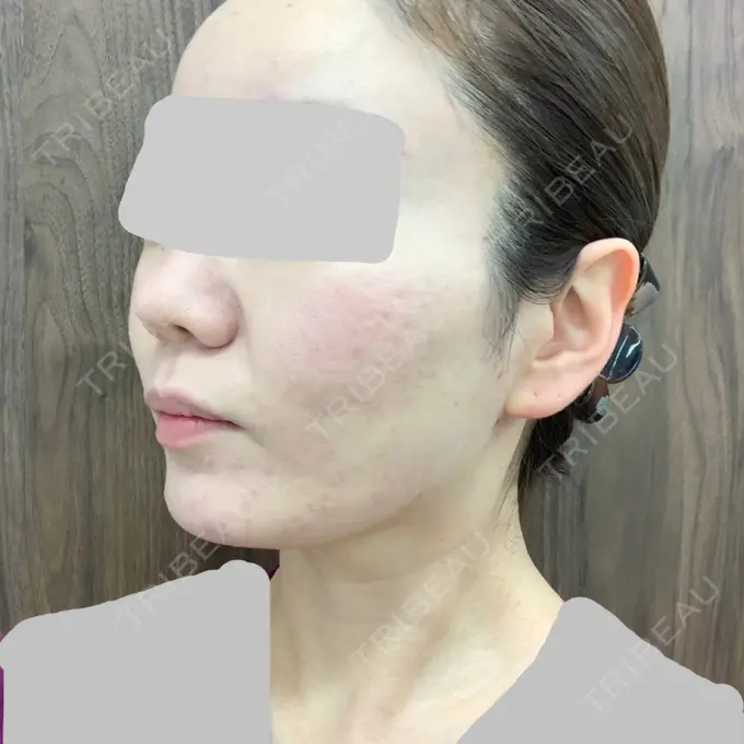 糸リフト / 肌ヒアルロン酸注入（たるみ・シワ改善） TCB東京中央美容外科 中野院 DAY 12 メイン用