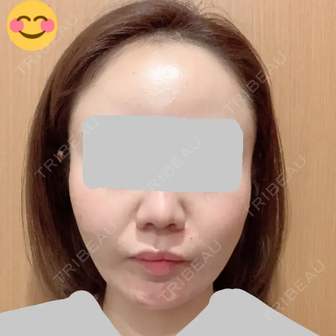 糸リフト / 肌ヒアルロン酸注入（たるみ・シワ改善） TCB東京中央美容外科 中野院 DAY 12 メイン用